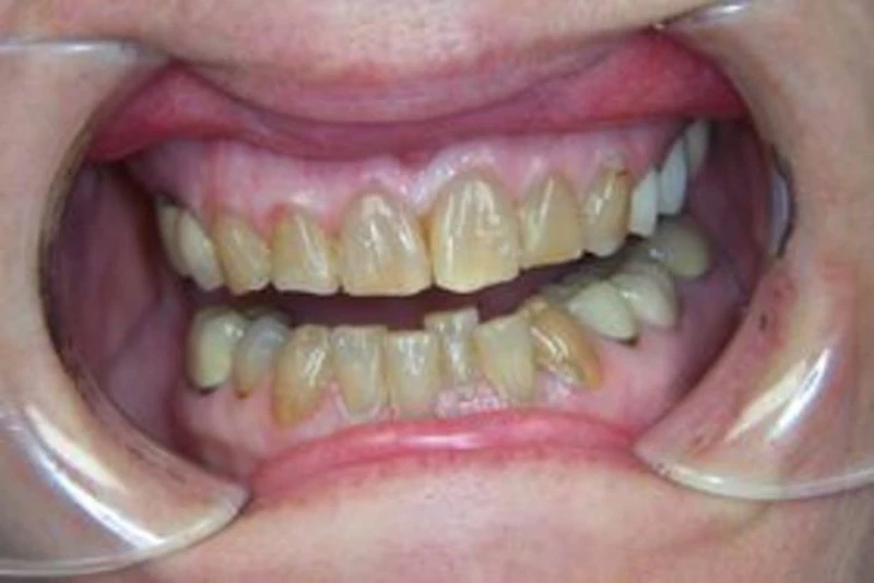 Smile before full mouth reconstruction