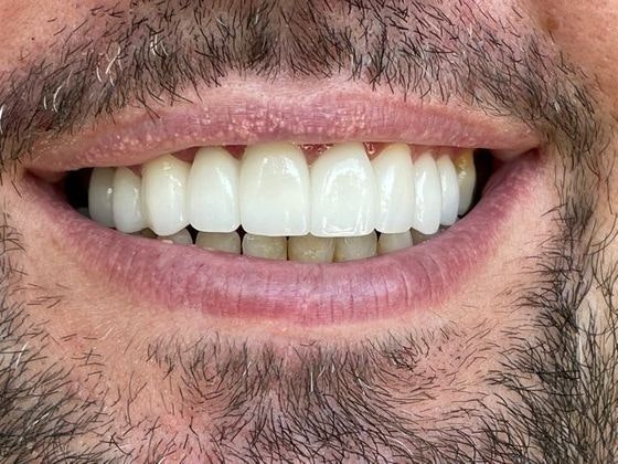 Dr. Clint Newman's patient after smile makeover