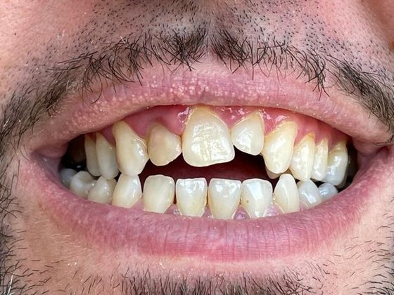 Dr. Clint Newman's patient before smile makeover