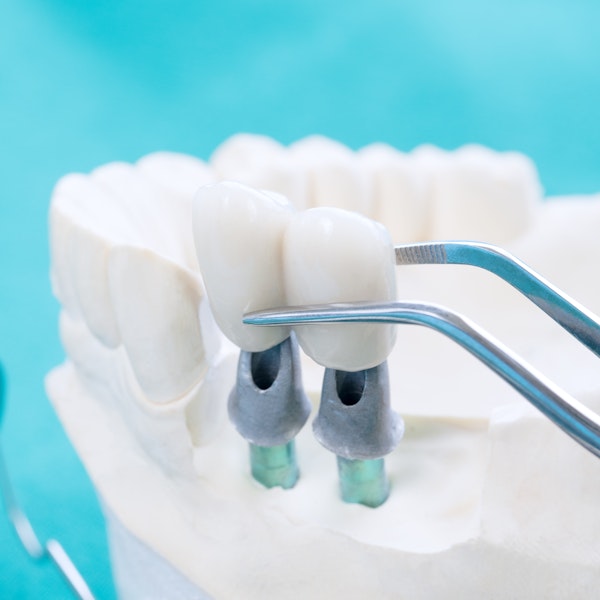 Implant supported bridge