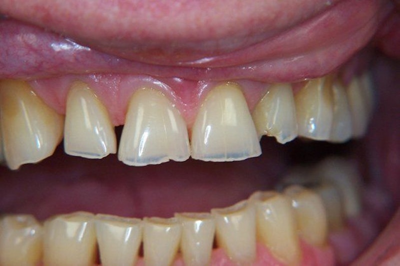 Clint Newman, DDS, patient before a smile makeover