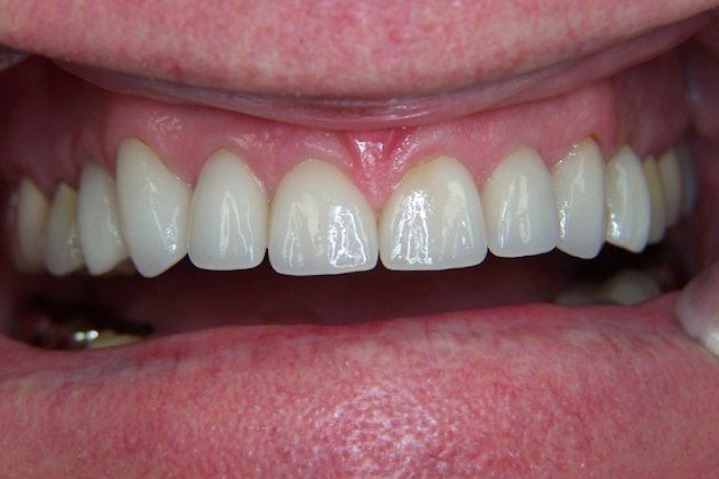 Clint Newman, DDS, patient after a smile makeover