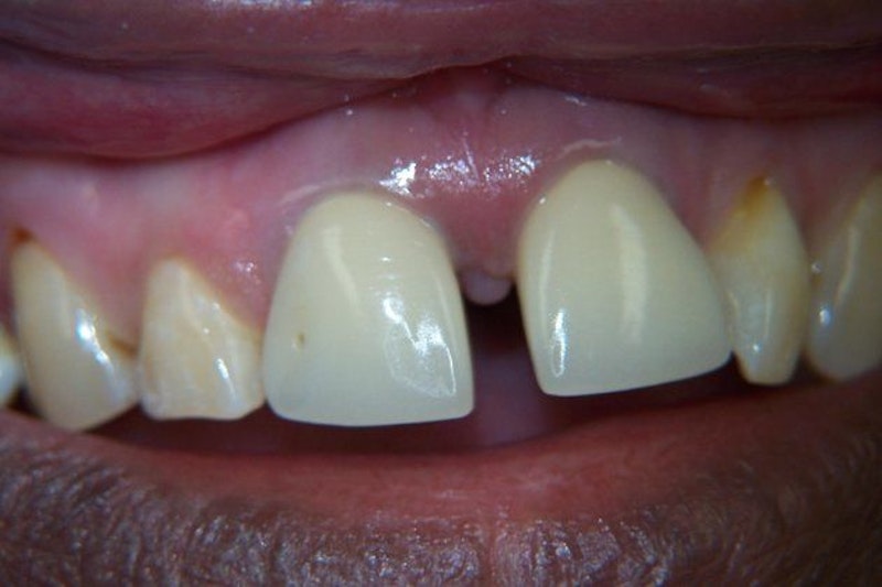 Clint Newman, DDS, patient before a smile makeover