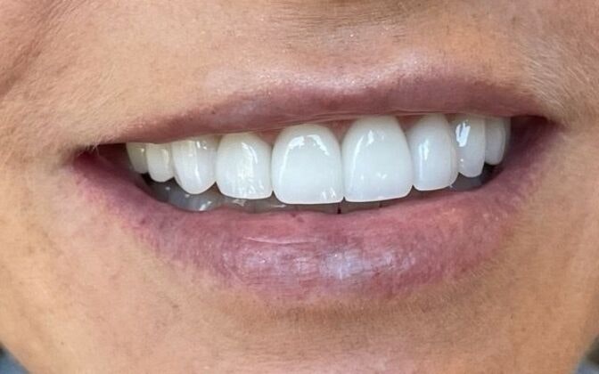 Dr. Clint Newman's patient after veneers