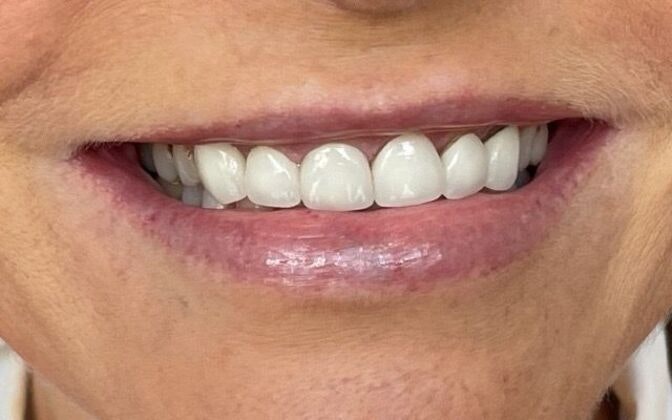 Dr. Clint Newman's patient before veneers