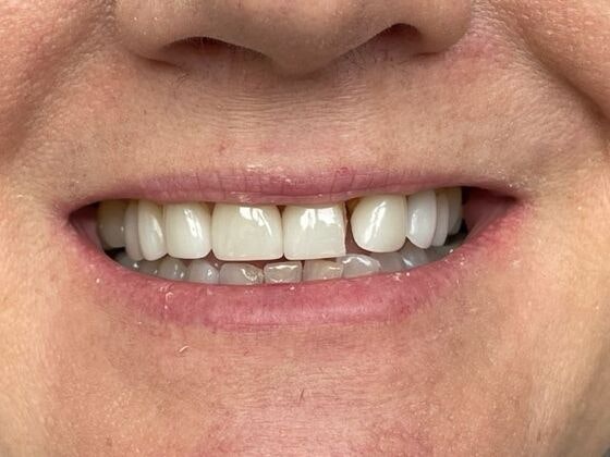 Dr. Clint Newman's patient before veneers