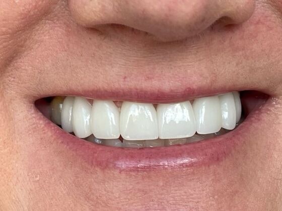 Dr. Clint Newman's patient after veneers