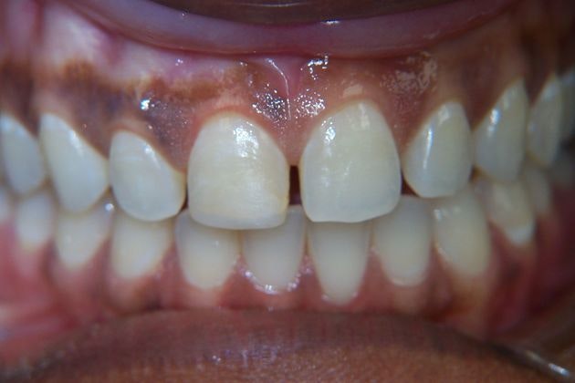 Dr. Clint Newman's patient before veneers