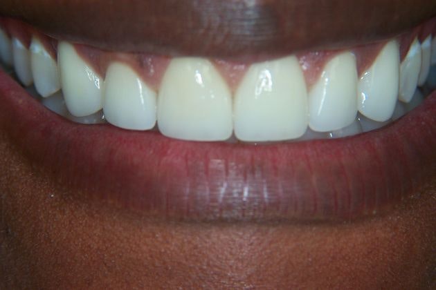 Dr. Clint Newman's patient after veneers