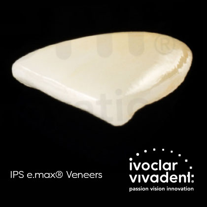 IPS e.max® Veneers