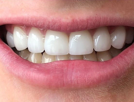 Dr. Clint Newman's patient after veneers