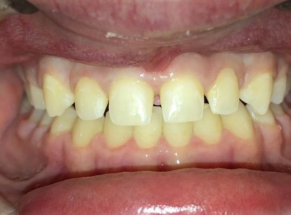 Dr. Clint Newman's patient before veneers