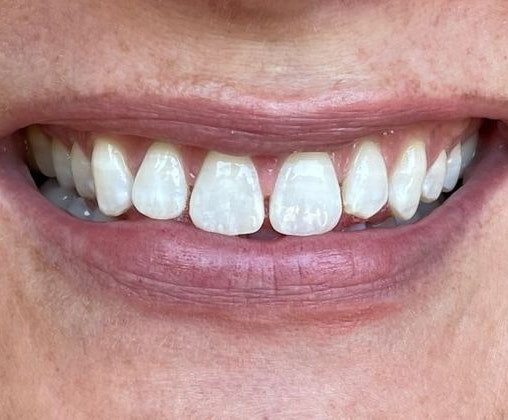 Dr. Clint Newman's patient before veneers