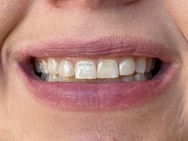 Dr. Clint Newman's patient before veneers
