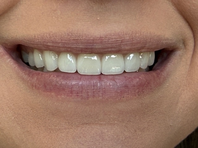 Dr. Clint Newman's patient after veneers