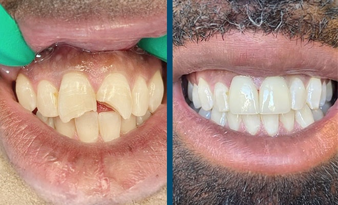 Before and after crowns with a chipped tooth