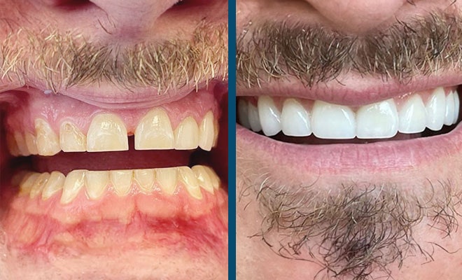 Before and after crowns with tooth gap