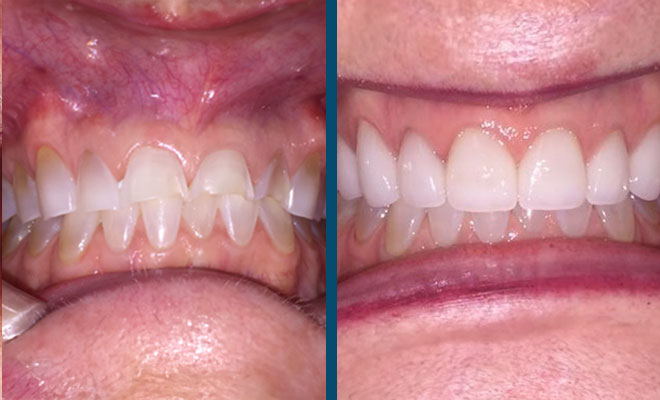 Before and after crowns with worn teeth