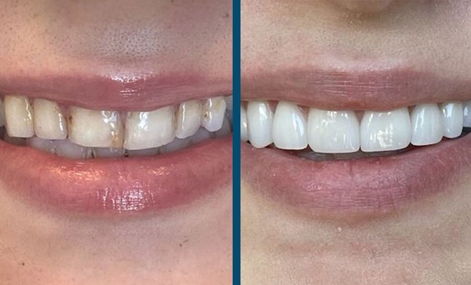 before and after crowns with stained teeth