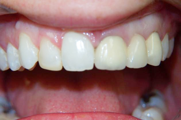 before full mouth reconstruction