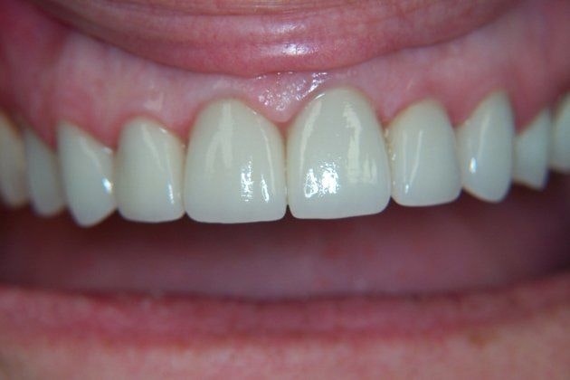 after smile makeover