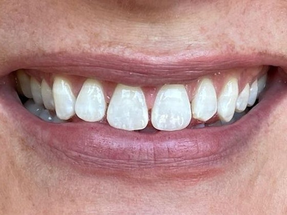 Discolored, spaced teeth