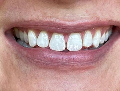 before veneers