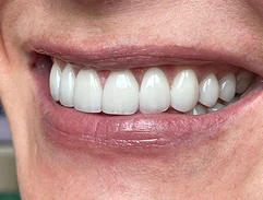 after veneers