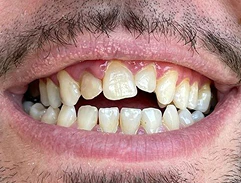 before smile makeover