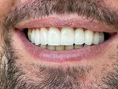 after smile makeover