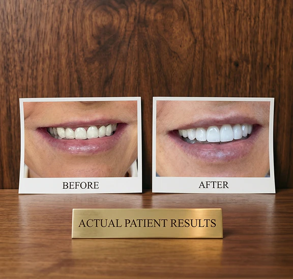 before and after a smile makeover