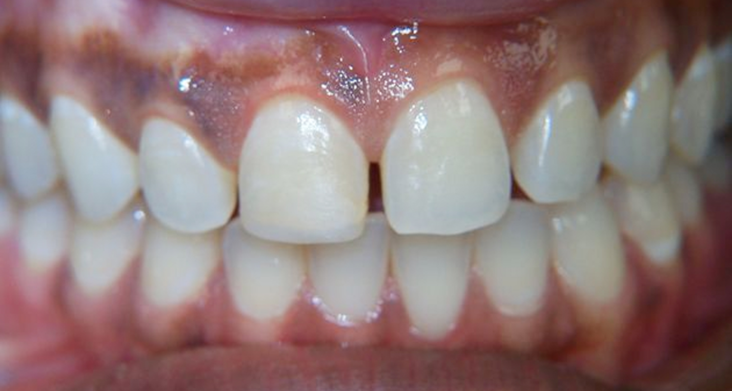Before Veneers