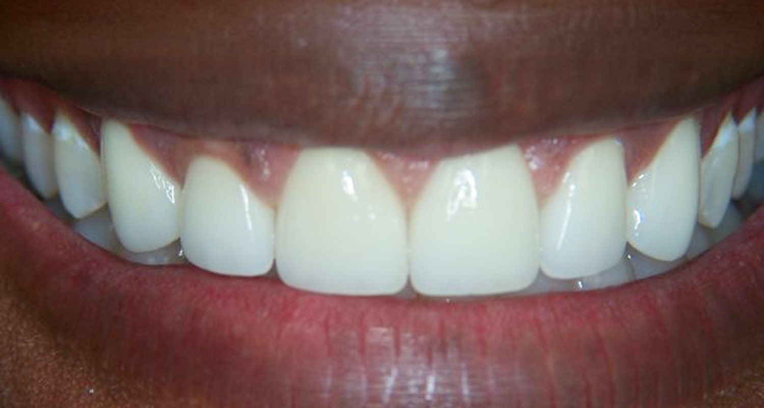 After Veneers