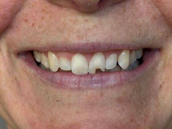 Before IPS e.max® veneers.