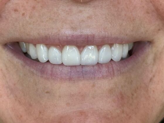 After Empress veneers.