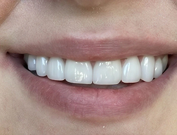 after dental treatment