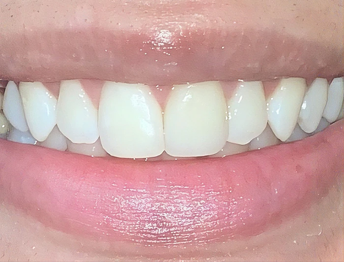 after dental crown work