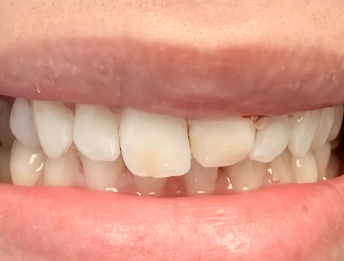 before dental crown work