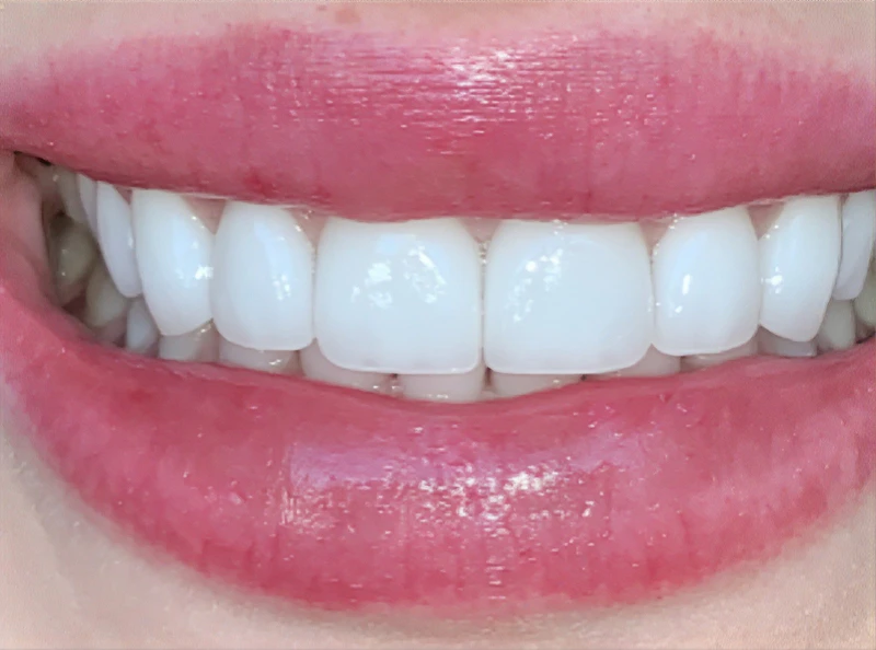 after veneers by dr. clint newman