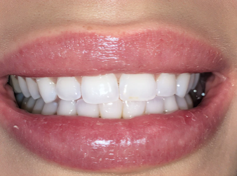 before veneers by dr. Clint newman