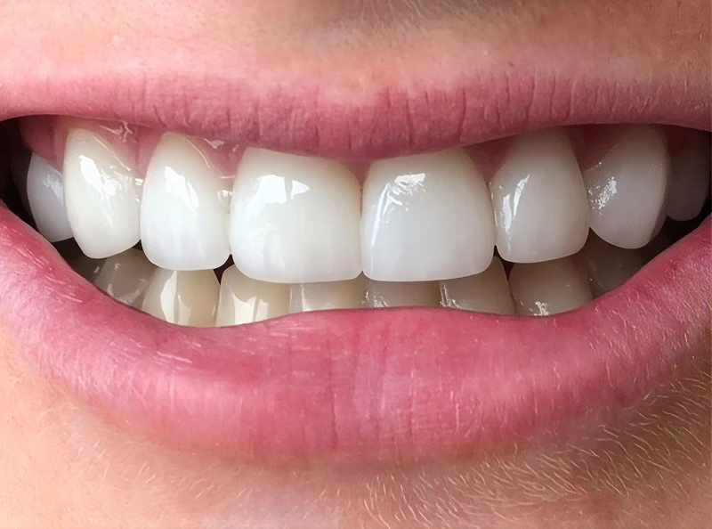 after veneers by dr. newman