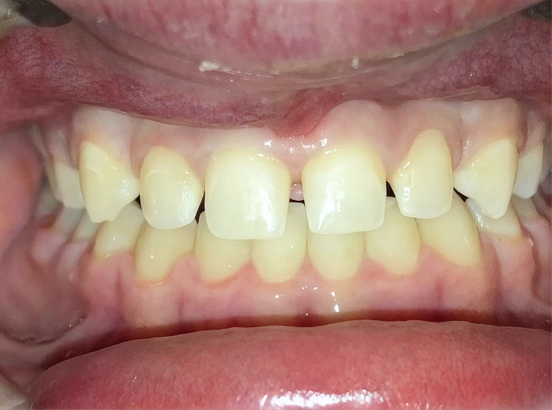 before veneers by dr. newman
