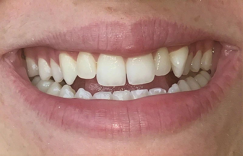Veneers Before