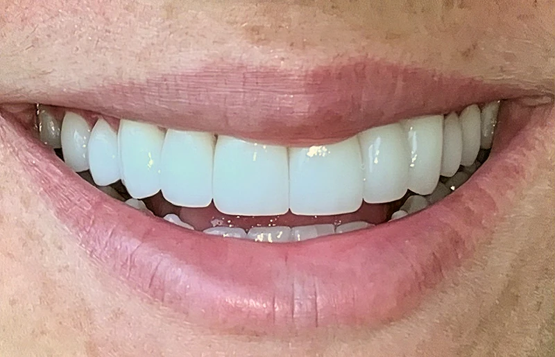 Veneers After
