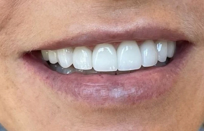 Veneers After Case 2