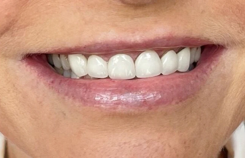 Veneers Before Case 2