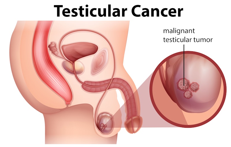 illustration of testicular cancer