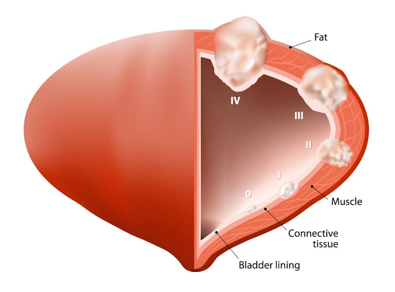 Illustration showing stages of bladder cancer