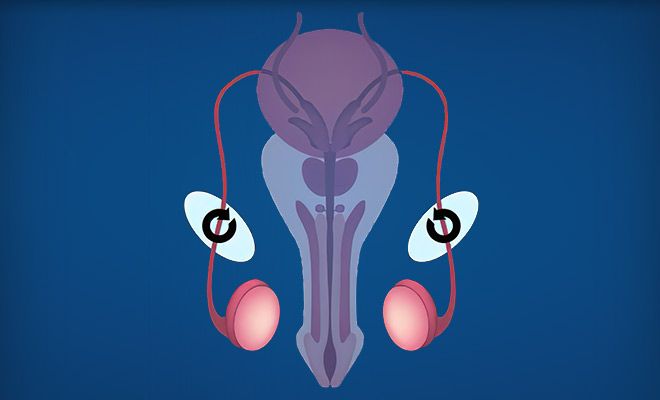 Diagram of vasectomy reversal