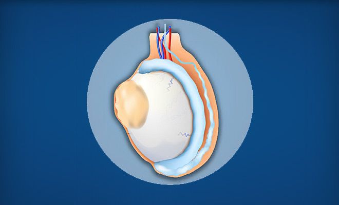 Diagram of testicular cancer